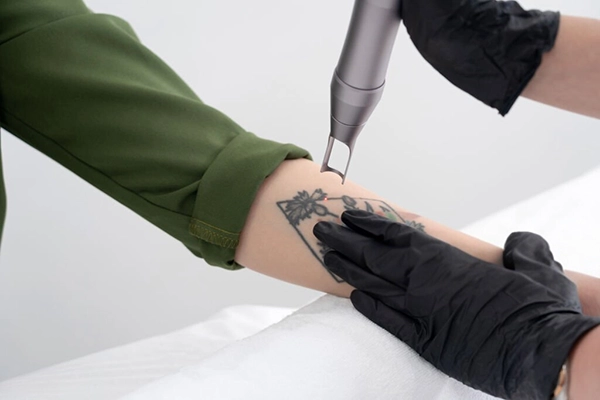 tattoo removal